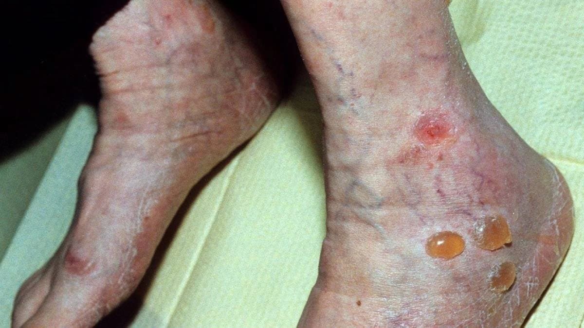 Diabetes Symptoms: these skin problems cause by diabetes should not ignored