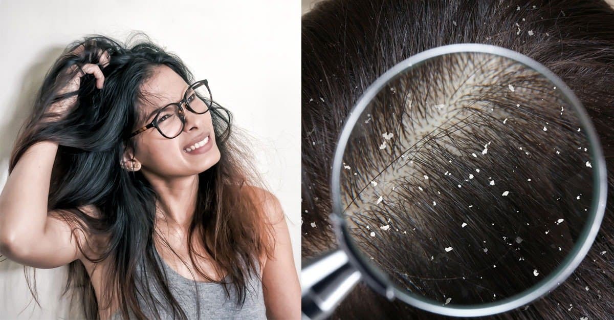 this home remedy helps to remove dandruff permanently here are all details lif