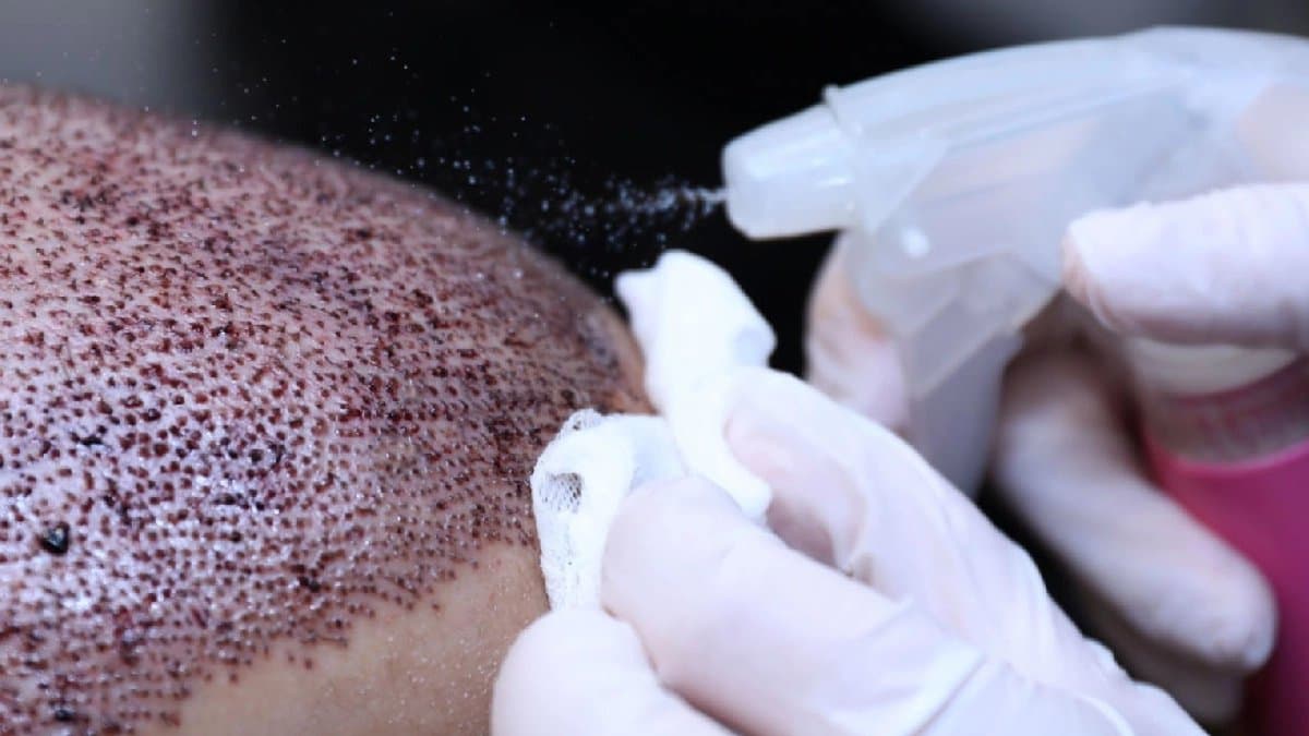 Hair transplant goes wrong tourist dies in Turkey aged 38
