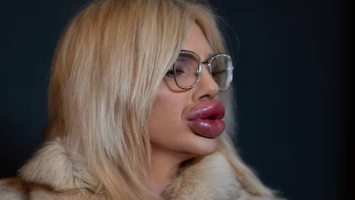 Worlds largest lips of spanish influencer