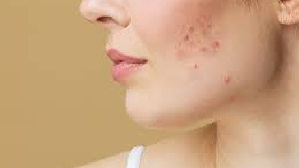 5 Things Cause Acne know the Reason Lifestyle