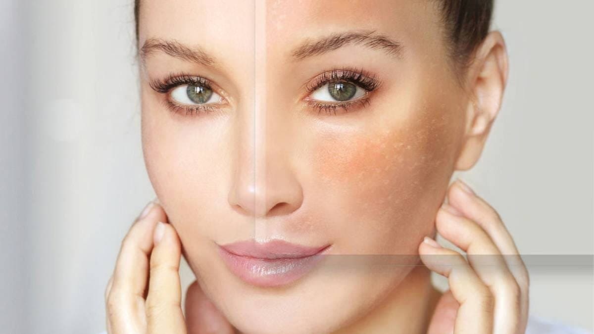  this home made natural face serum can easily remove all acne, dark spots from your skin and make the skin bright and beautiful lif 