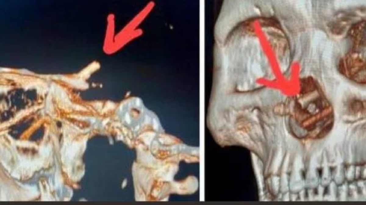  5 Month Headache Leads To Shocking report of  CT Scan