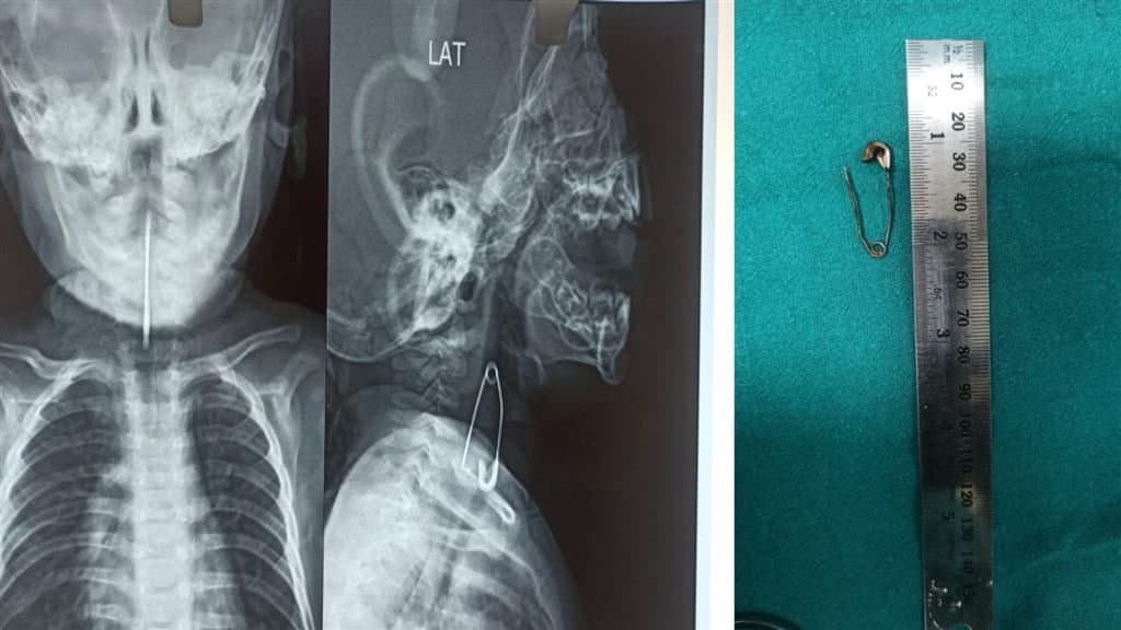 five-month-old-baby-successfully-operated-at-calcutta-medical-college-u30l