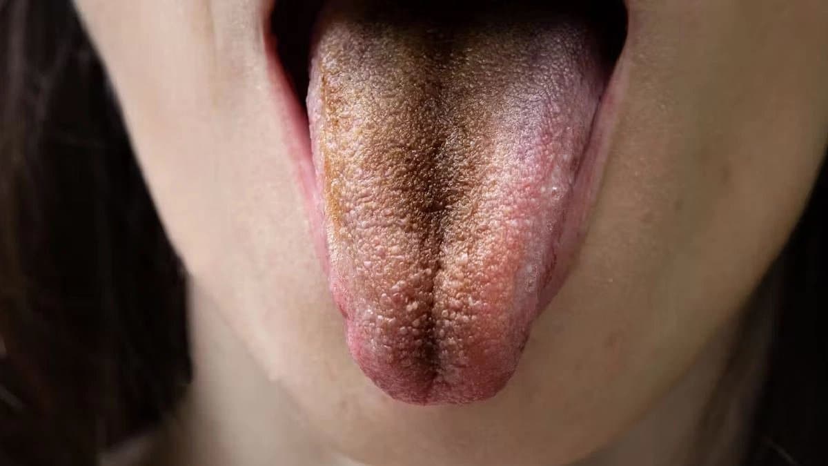 Why tongue Cleaning is very important for Dental Hygiene