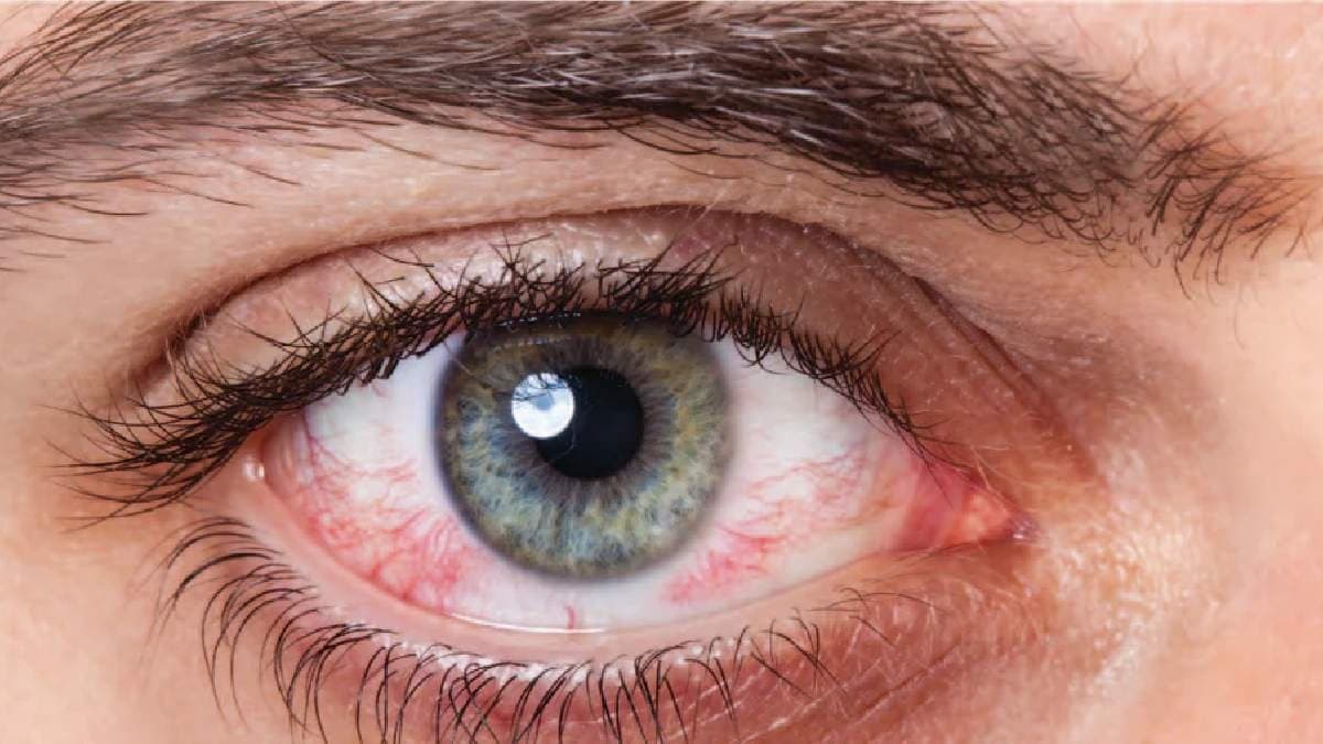 Rare symptom of Diabetes: Diabetic retinopathy