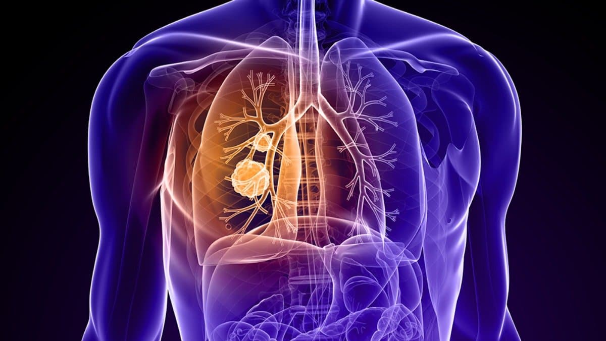 What is the reason of rise in number of Lung Cancer patient among the young generation