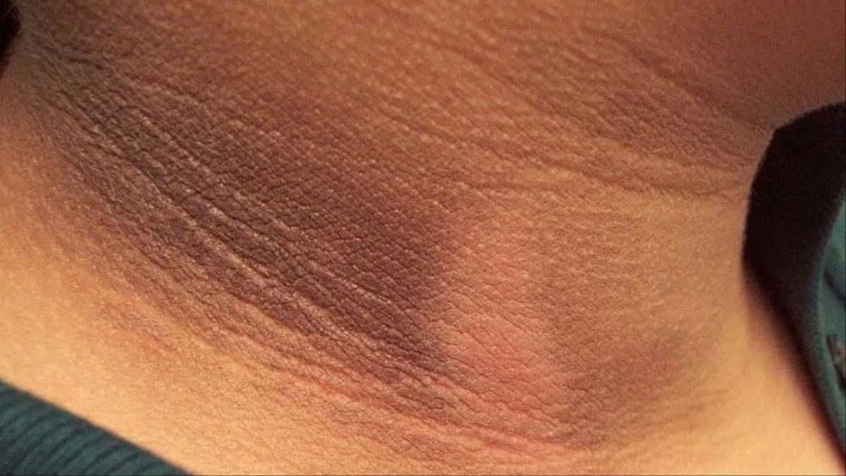 How to get rid of black neck dark patches during Durga Puja 2025