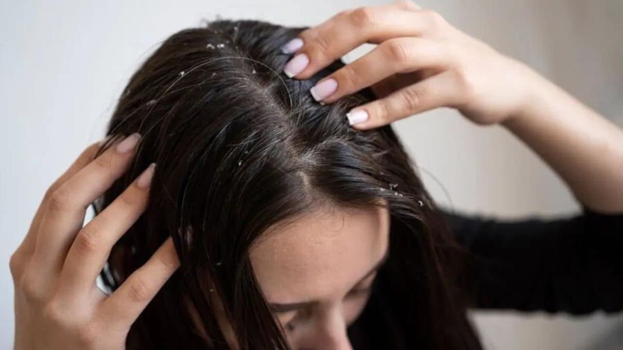 this hair oil reduce dandruff problem  quickly lif