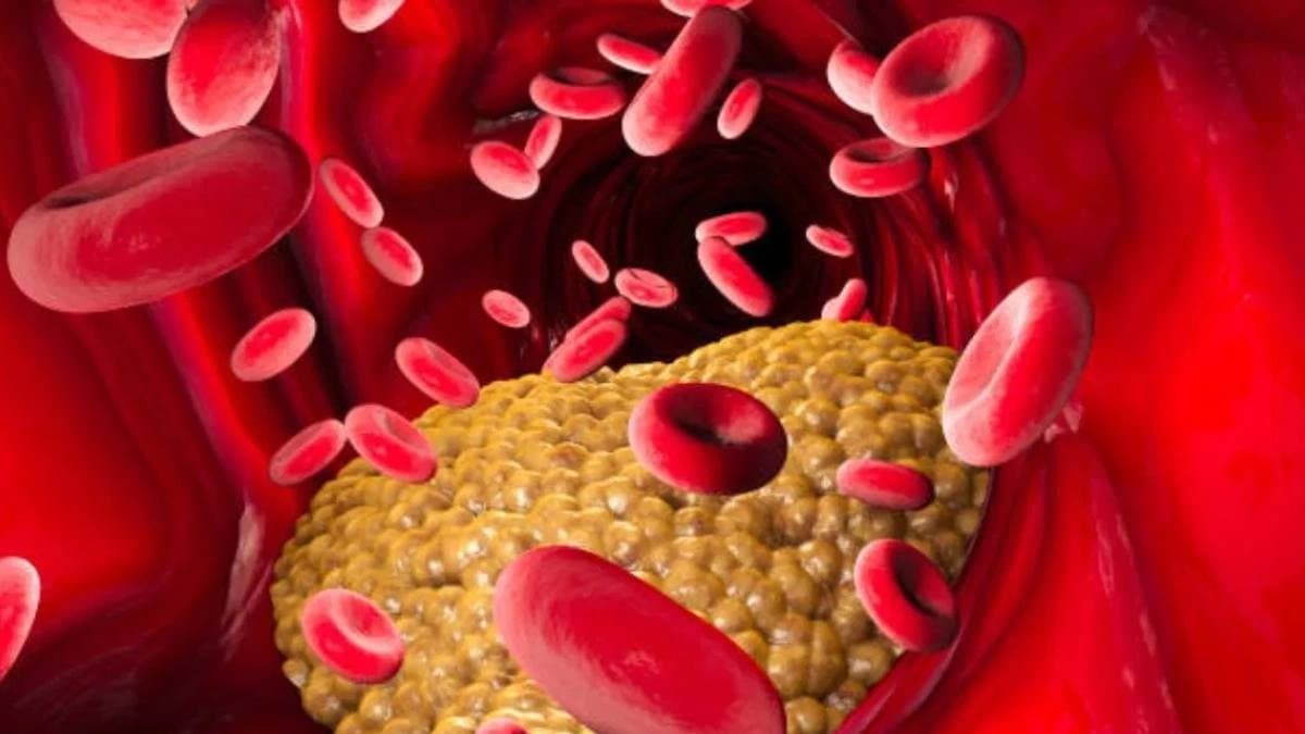 Pain in these parts of body indicate high cholesterol  symptoms which should not ignored