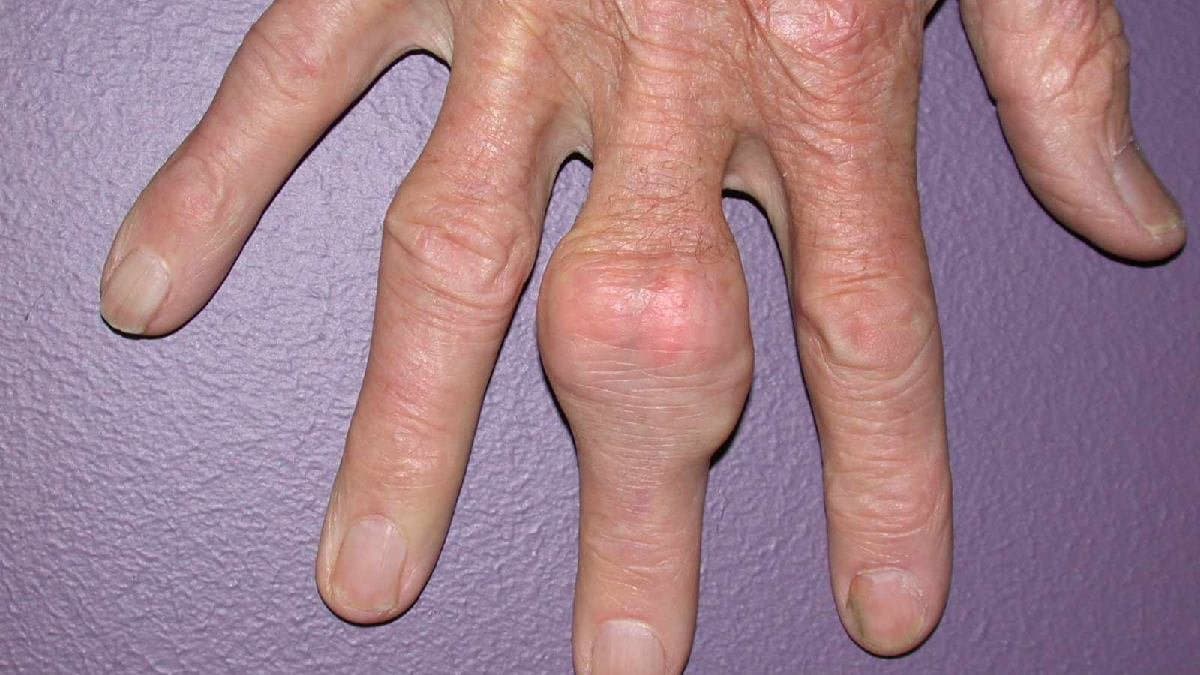 These are the symptoms of high uric acid