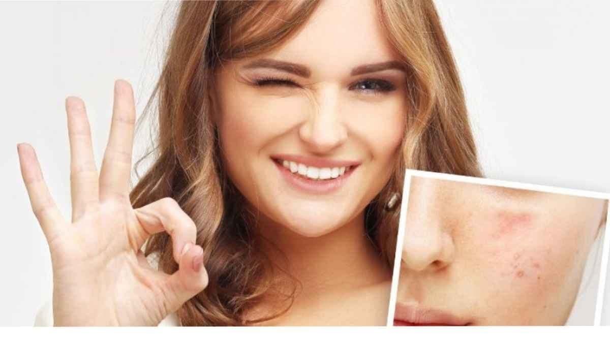 this home made natural face pack can  remove acne and finelines is a secret beauty pack of actress Malaika Arora lif