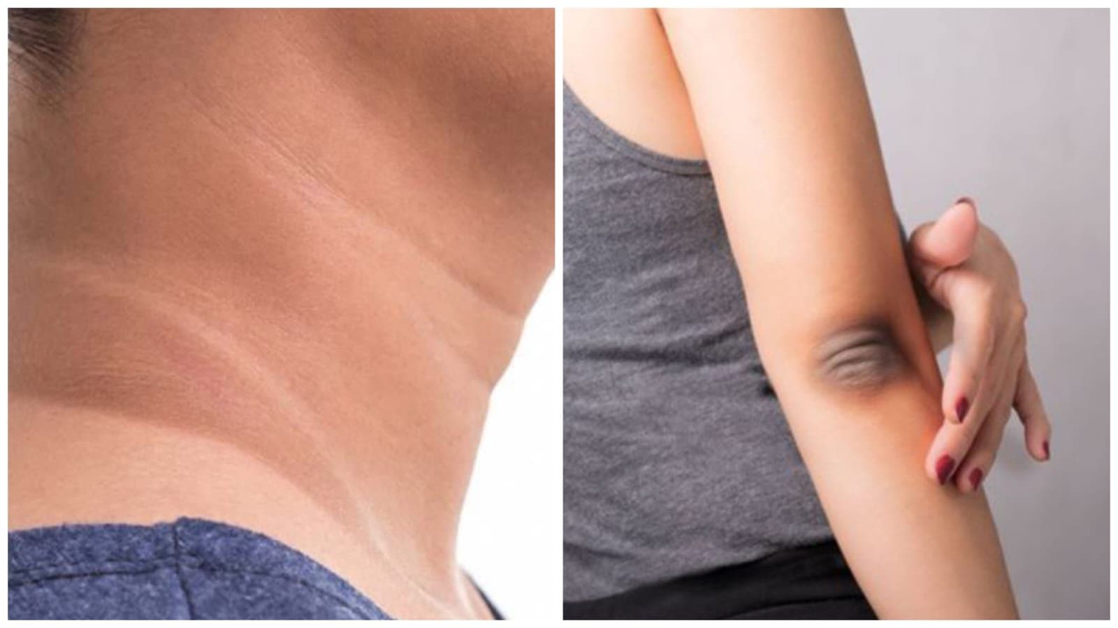 This remedies can brightening your black neck and elbow within one month lif