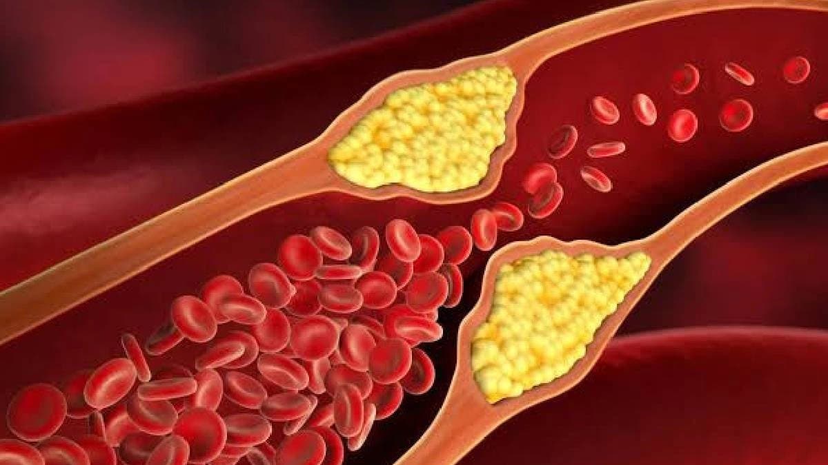 Cholesterol test should start at the age of twenty 