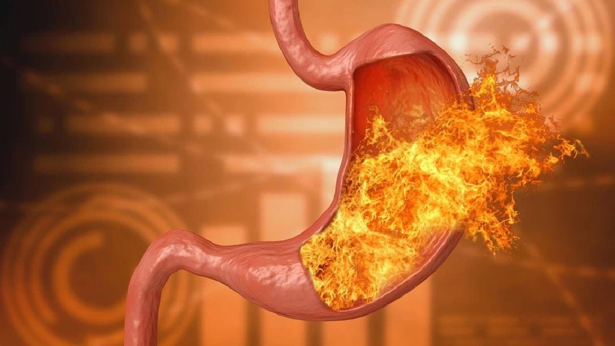 Five Home Remedies of GERD and Acid Reflux