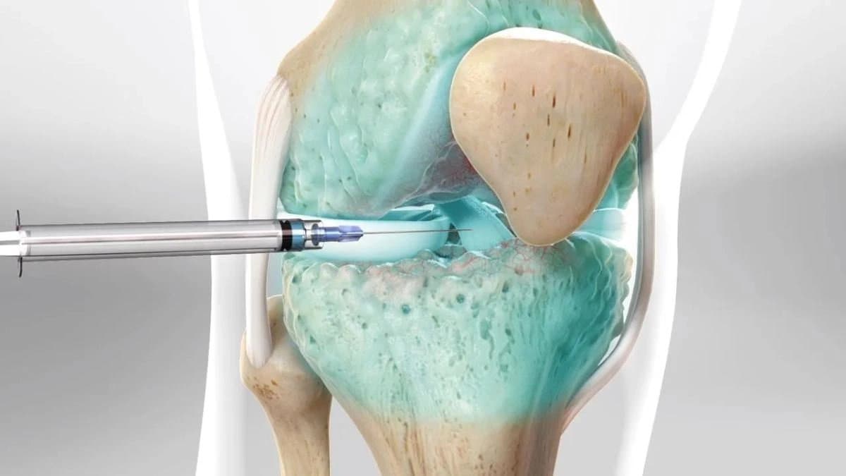 New hydrogel repairs Knee and Hip Joint Cartilage in joint pain patients without Joint Replacement Surgery