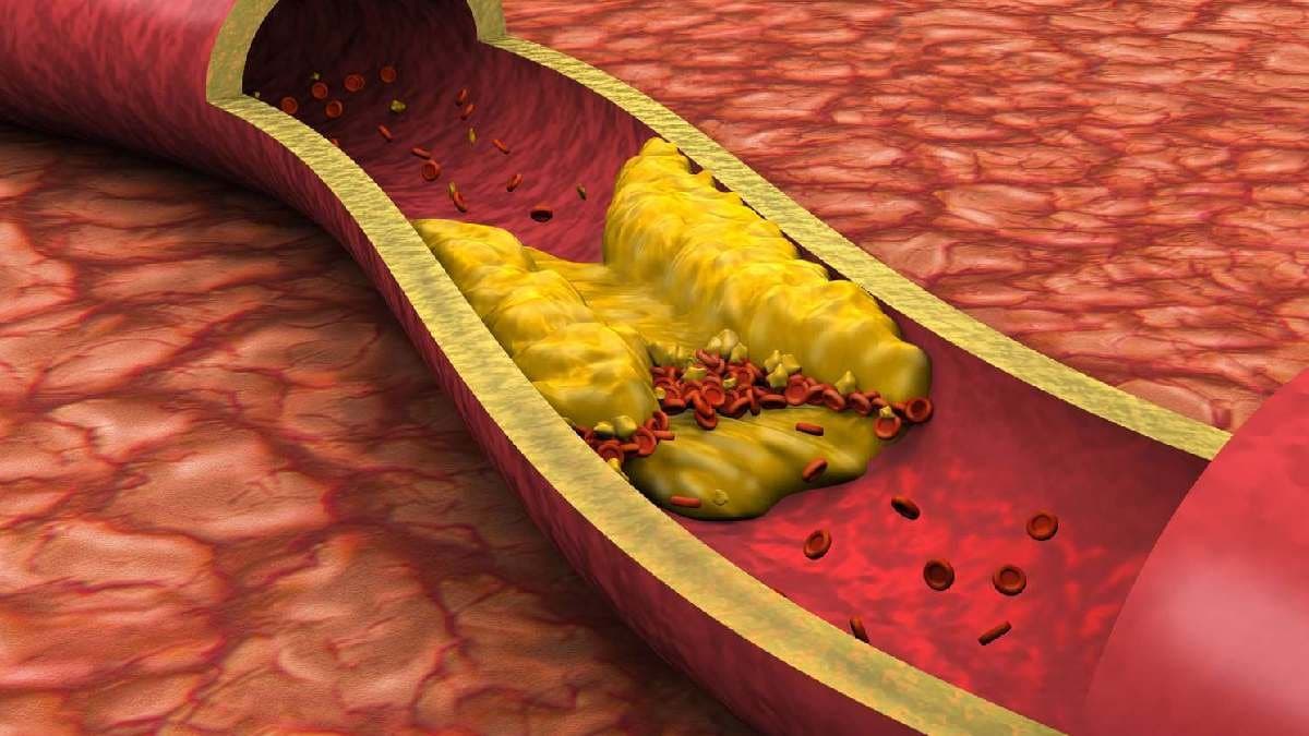 Clogged arteries to detox Liver five health benefits of Garlic