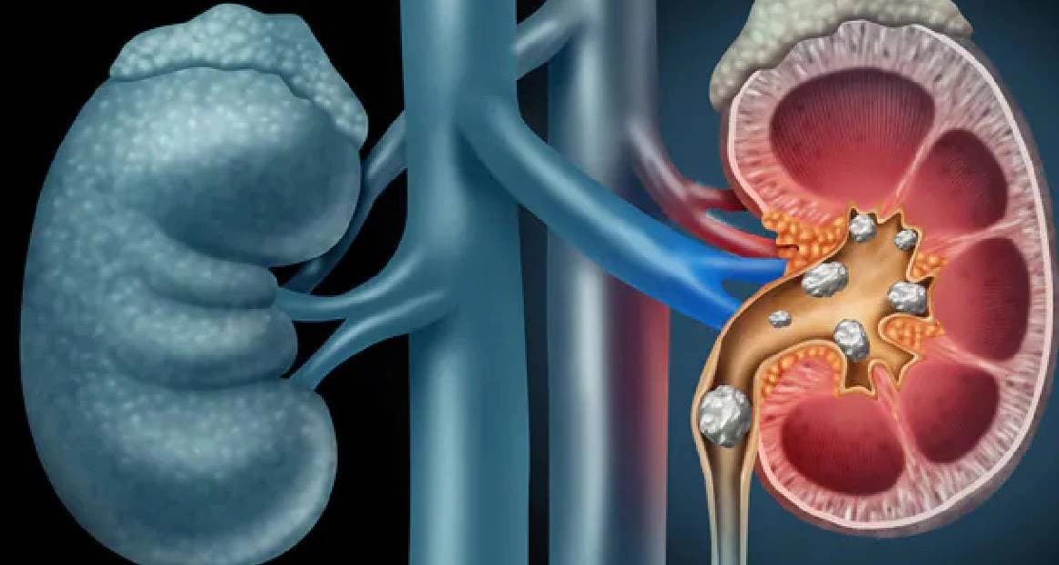 Health tips foods to avoid for kidney stone