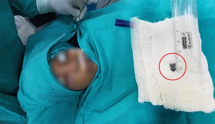 successful surgery at Kolkata Medical