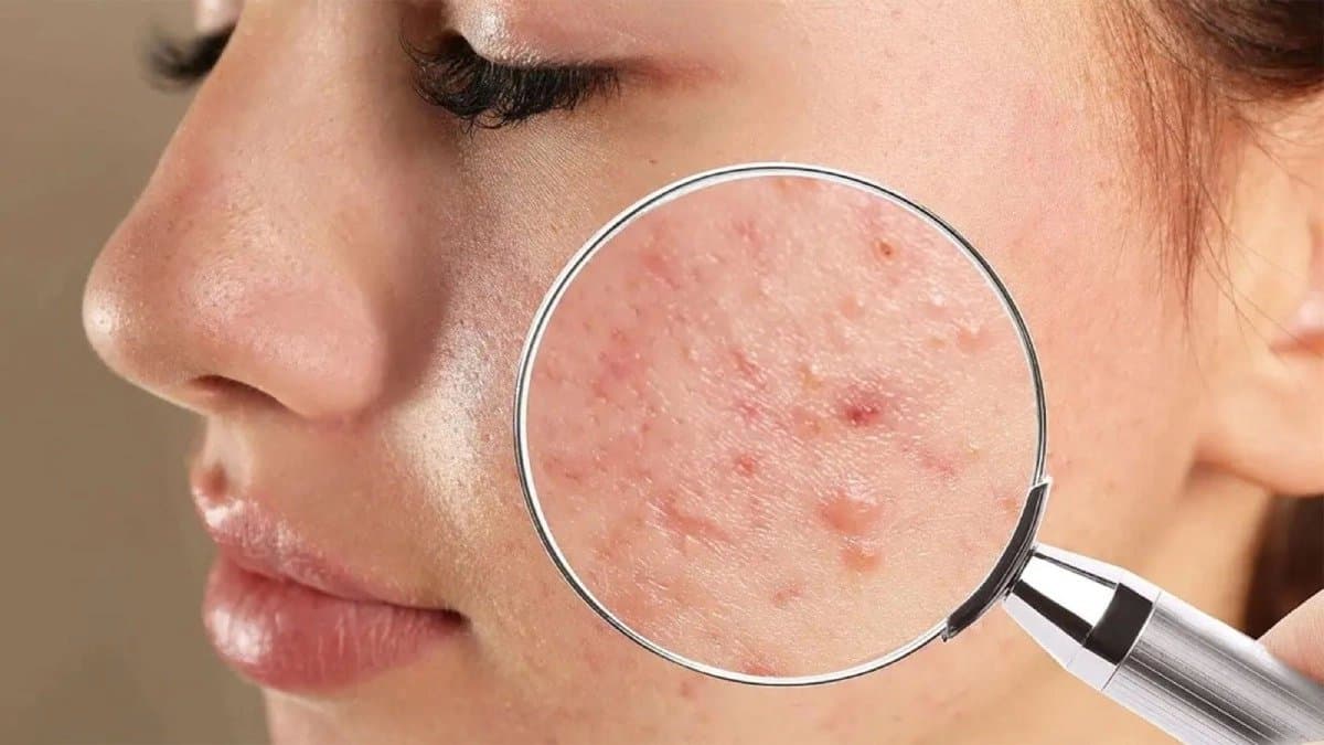 Pimple of face can indicate about your sickness 