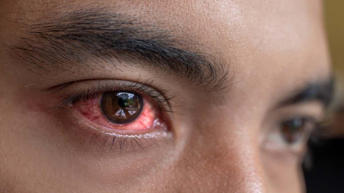 Why cases of conjunctivitis increases during monsoon season