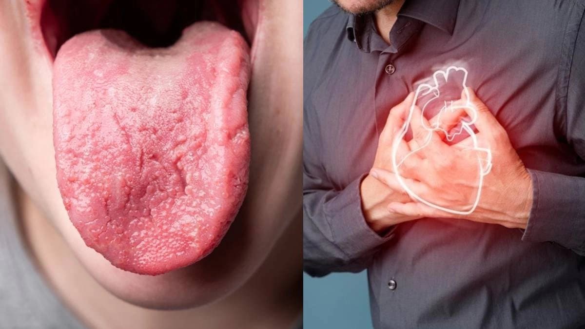 Heart Attack Prevention: Tongue can indicate about heart problems