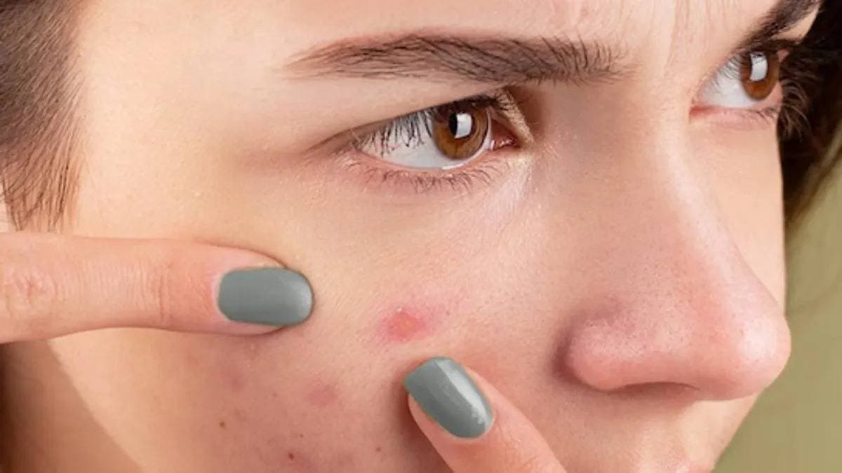 These skincare tips reduce pimples instantly and help to get flawless skin during summer 