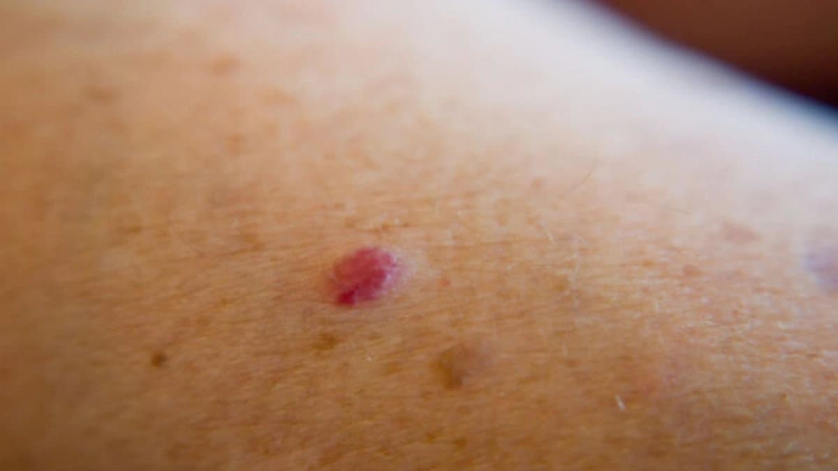 What Causes These Red Moles And Are They Dangerous