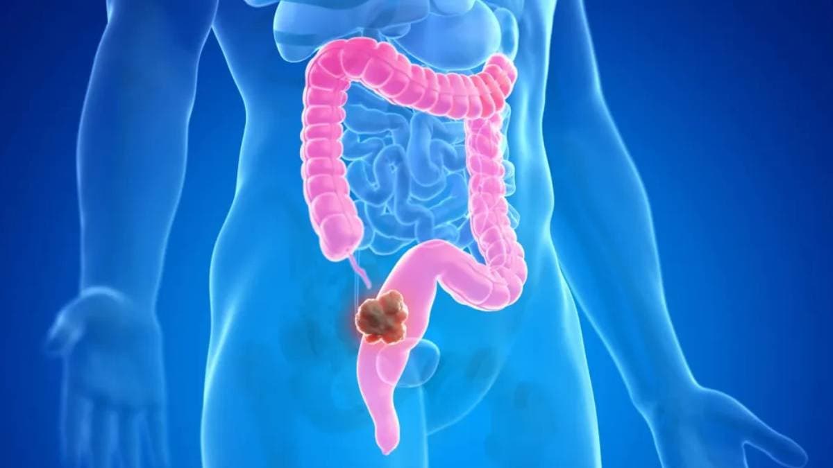 Number of Colon cancer patients are increasing in India