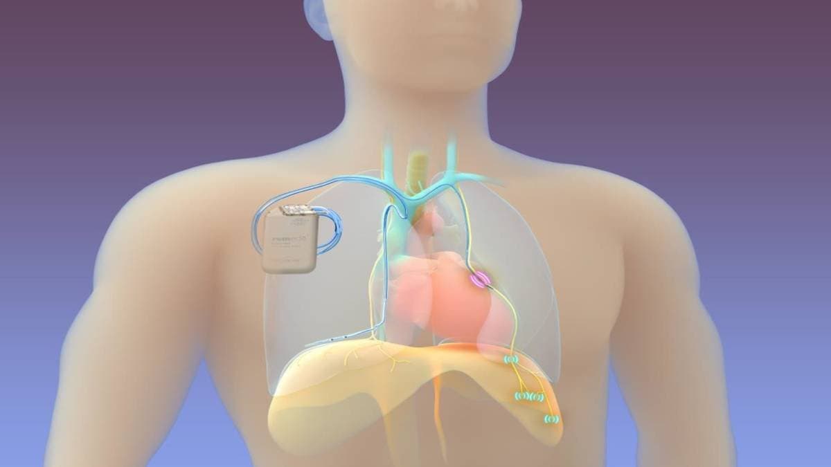 success of phrenic nerve neuromodulation surgery in pune