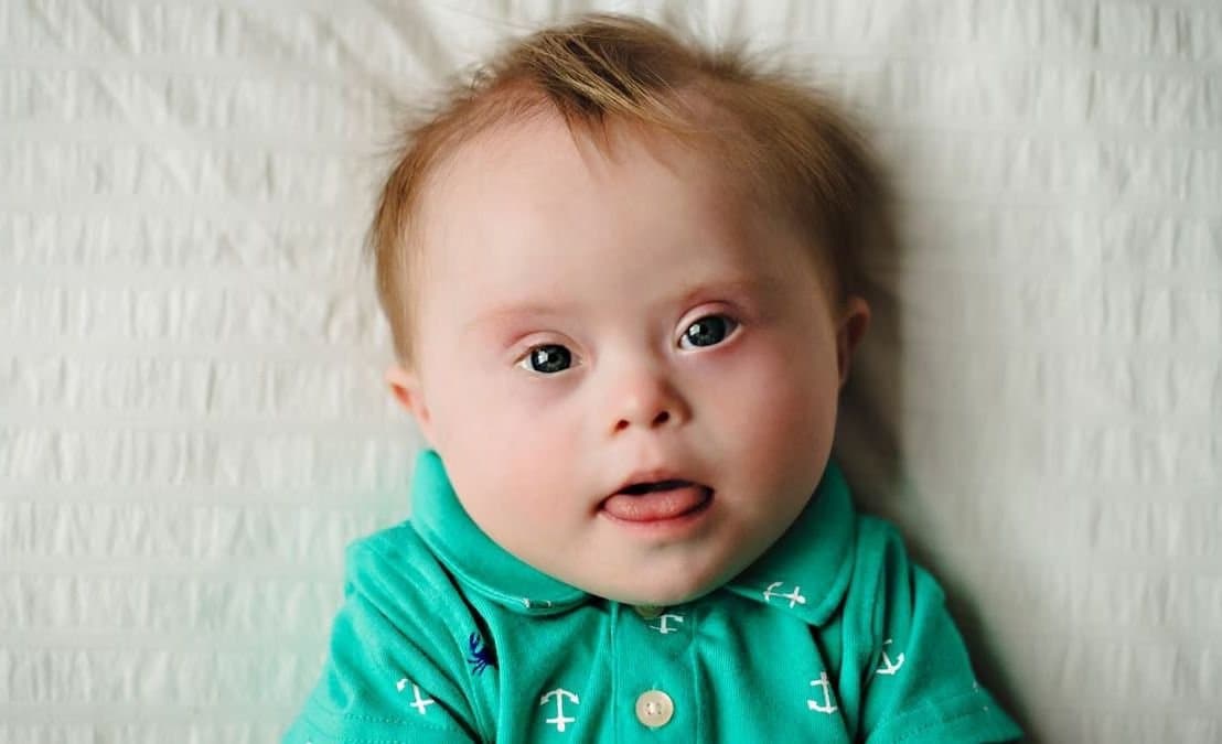Parenting: ডাউন সিনড্রোমে আক্রান্ত সন্তান? অভিভাবকদের কোন দিকে সচেতন হওয়া দরকার ?