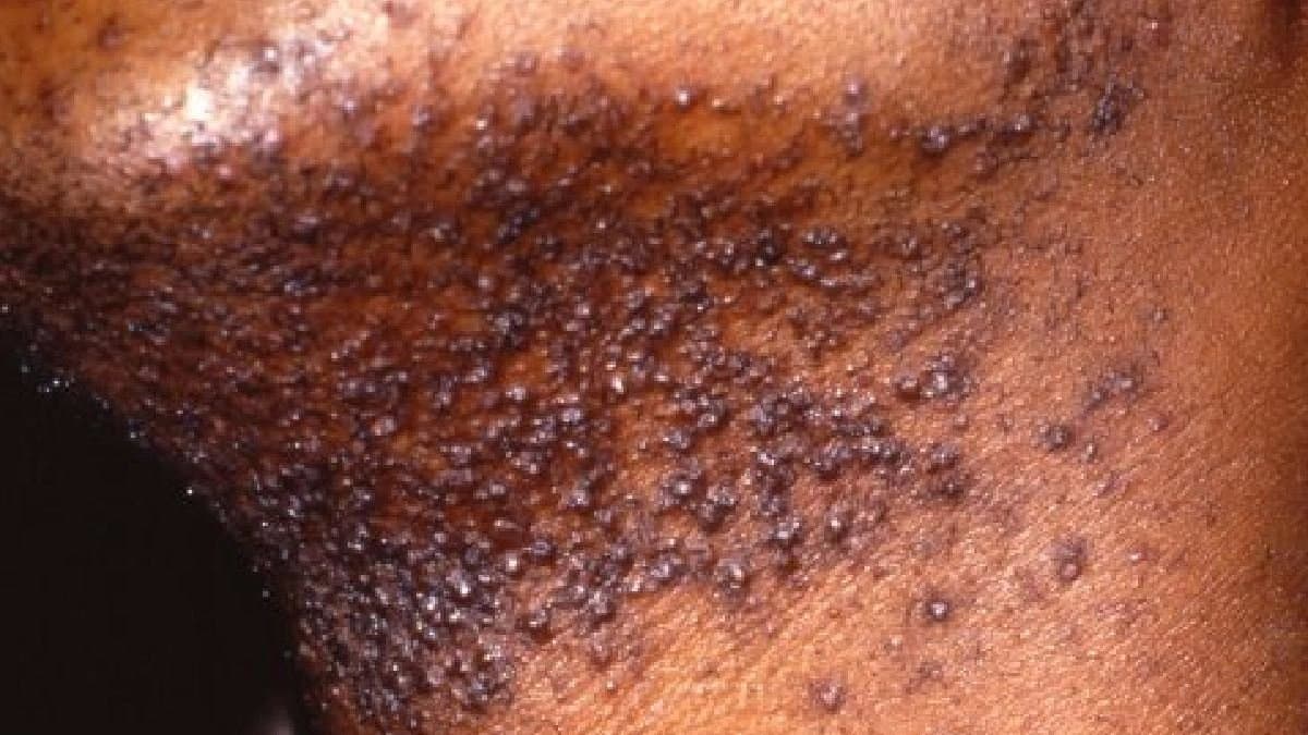 Razor Burn Remedy: How to reduce inflammation during shaving