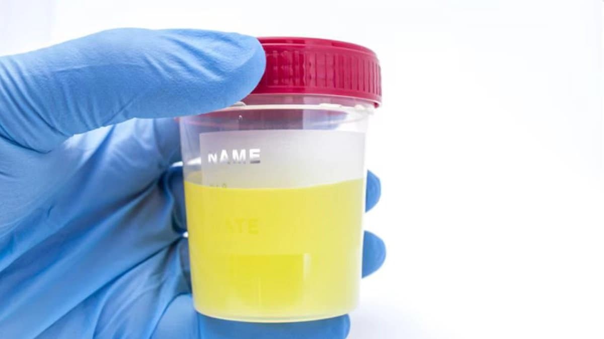 Common Causes of Cloudy Urine And What It Could Mean For Your Health