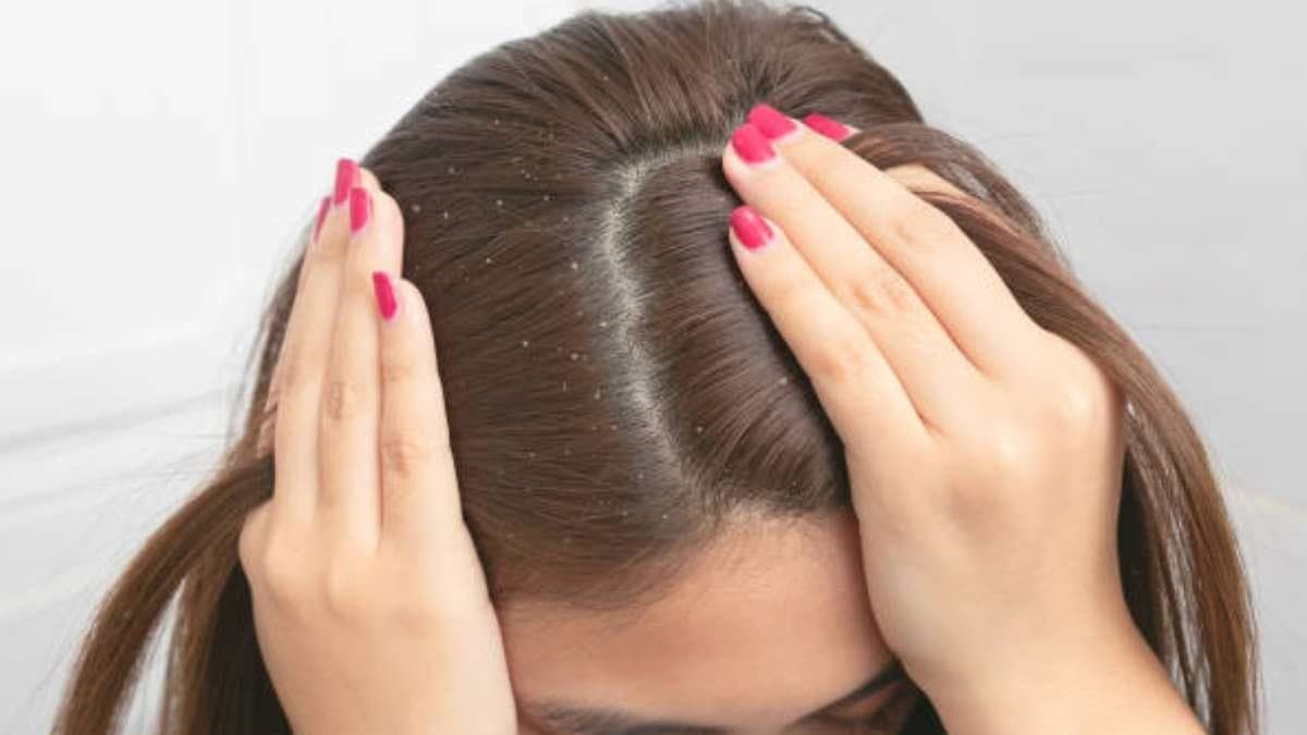 these all tricks can prevent dandruff and fungus problem and make your scalp healthy and clean lif