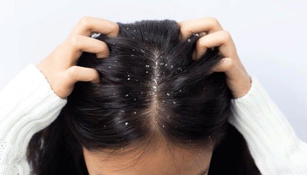 these home remedies prevent dandruff problem know all details lif