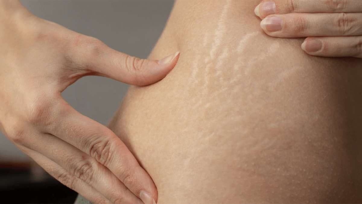  this home made natural remedy can prevent strech marks and make your skin tone tighten lif 