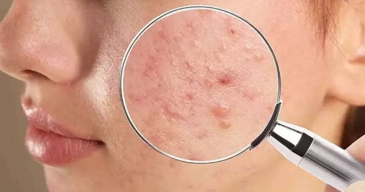 this homemade facewash helps to solve pimple problem lif