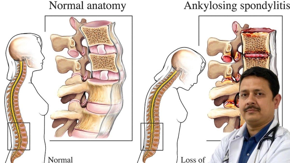 Early detection can cure Ankylosing Spondylitis