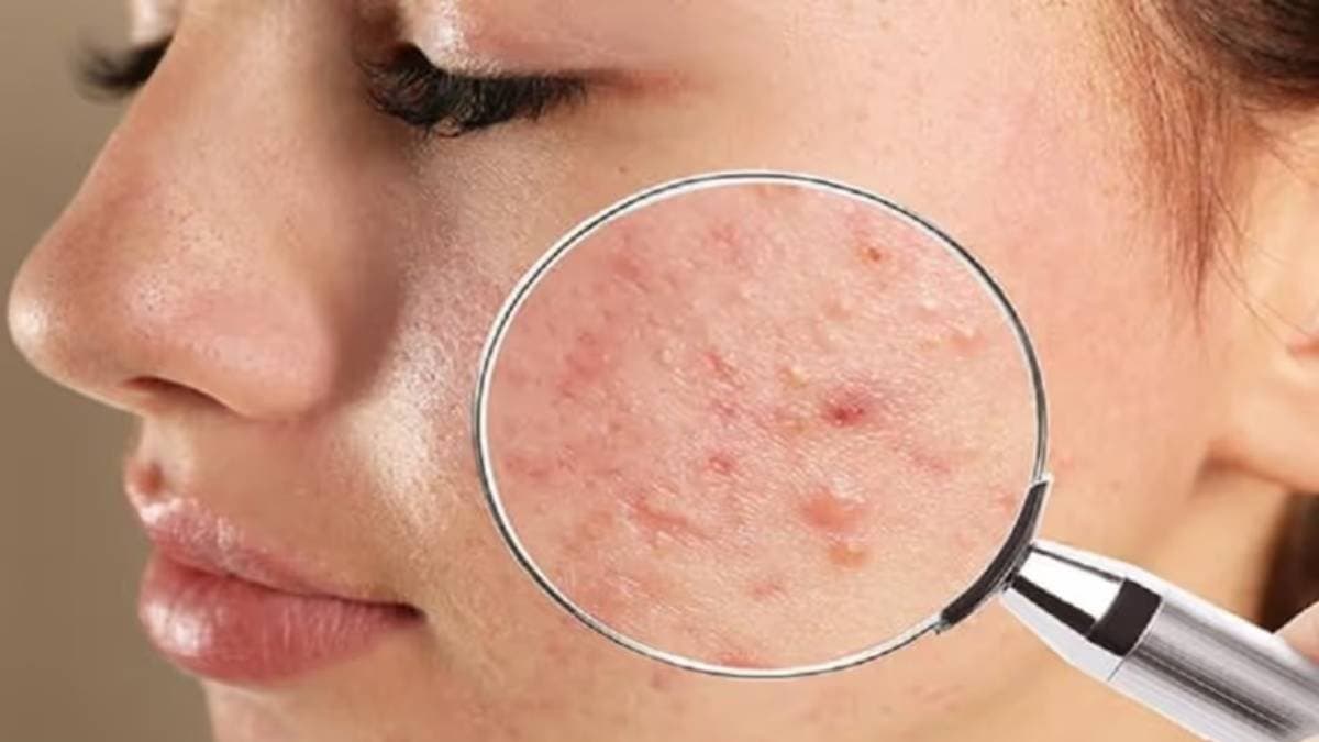 These homemade herbal face packs reduce acne instantly