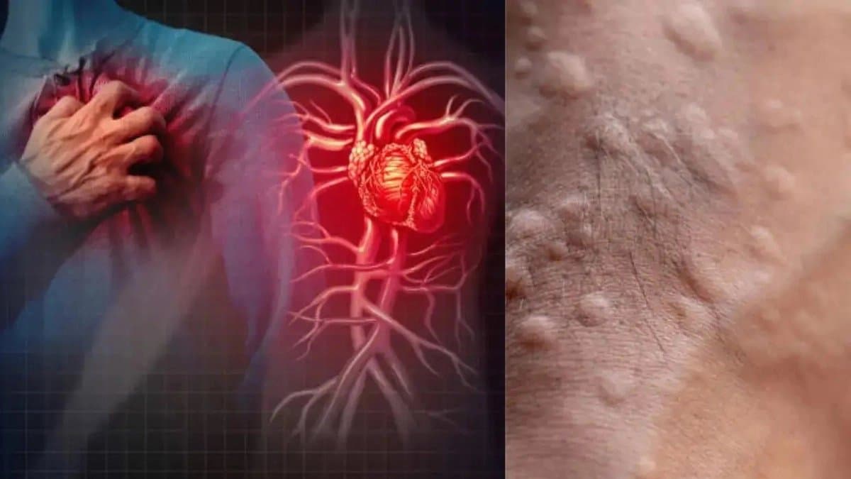 Heart Attack Symptoms: These warning signs of heart diseases appear on skin 