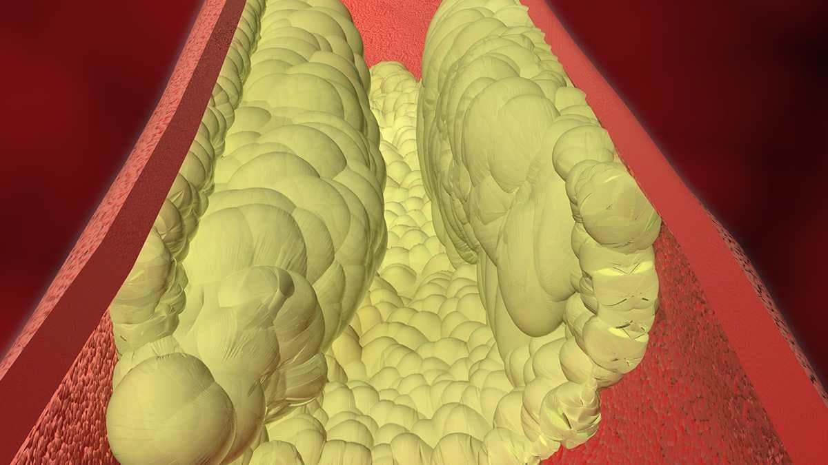 foods you should avoid for cholesterol and heart attack