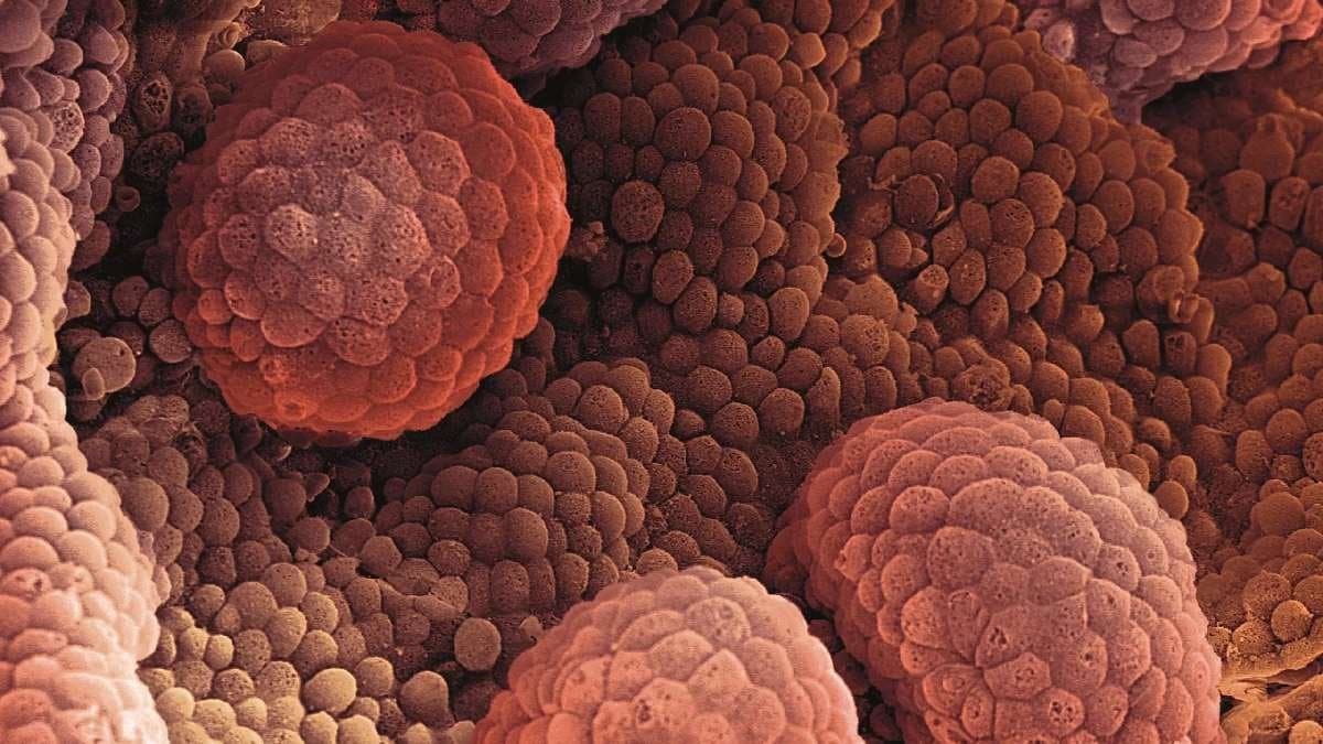 Mens Health: Urine problem among top symptoms of prostate cancer