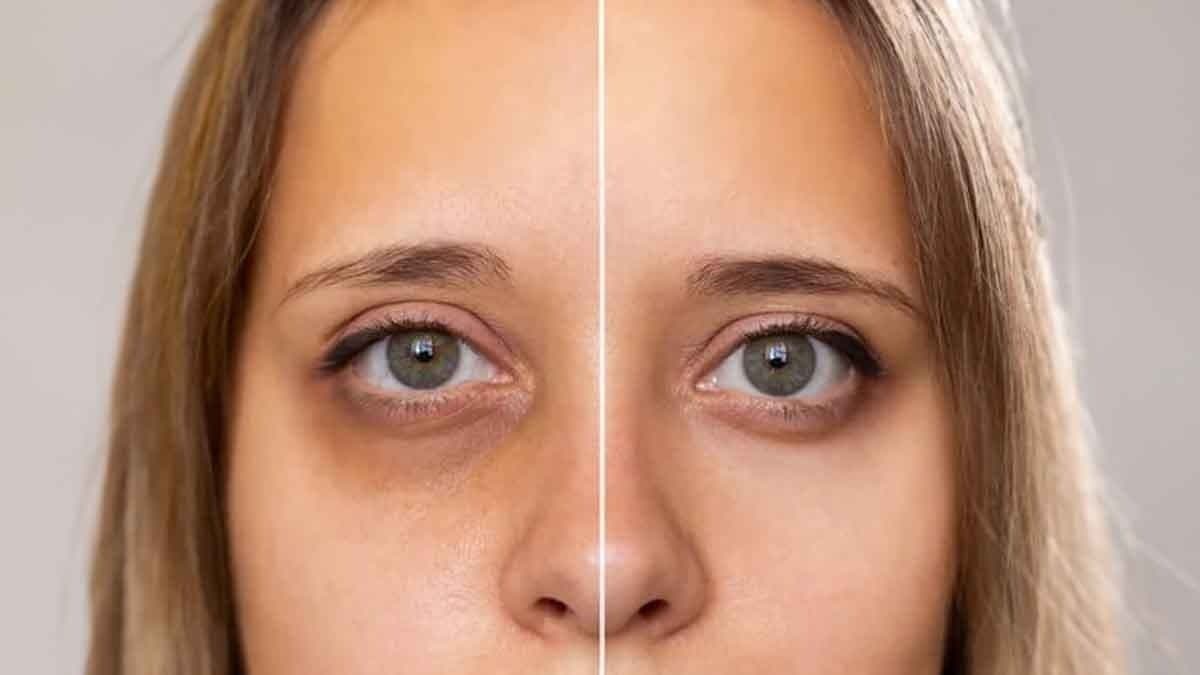 This home made natural under eye cream can remove dark circles within seven days lif