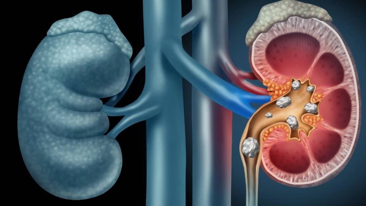 Scientists have engineered a bacteria that safely break down kidney stones