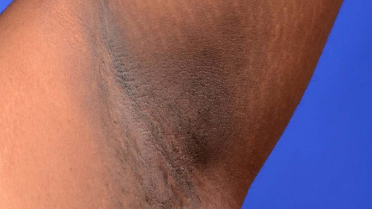 Three Home Remedies of Dark Underarm