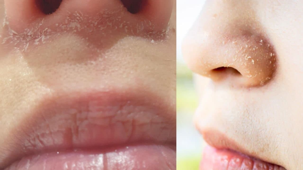Say Goodbye to Flaky Skin Around the Nose This Winter: Here is the Solution