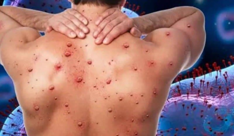 Lockdown to be imposed again due to mpox