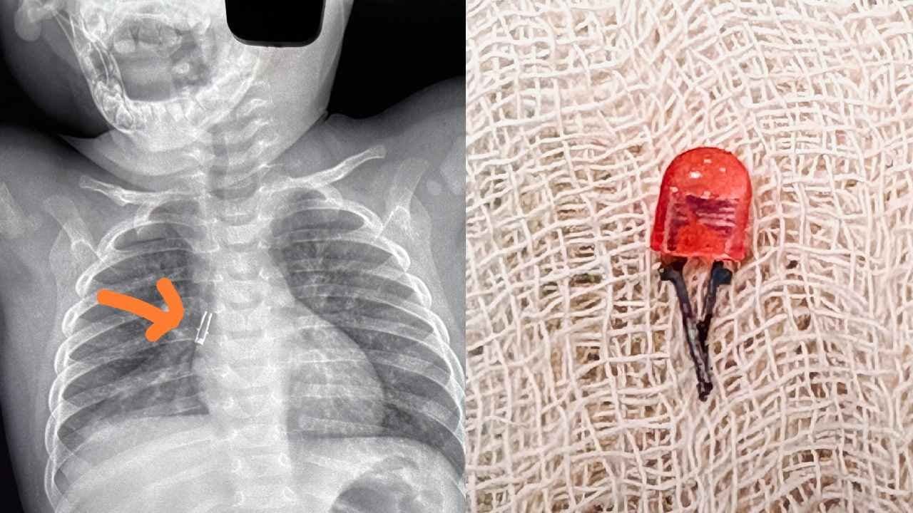 Rare operation takes place in NRS Hospital