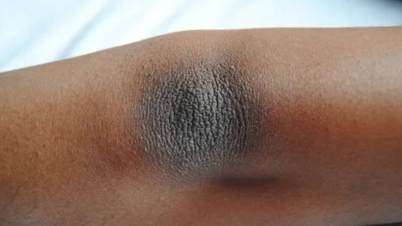 Darkened elbows could be symptoms of many critical diseases