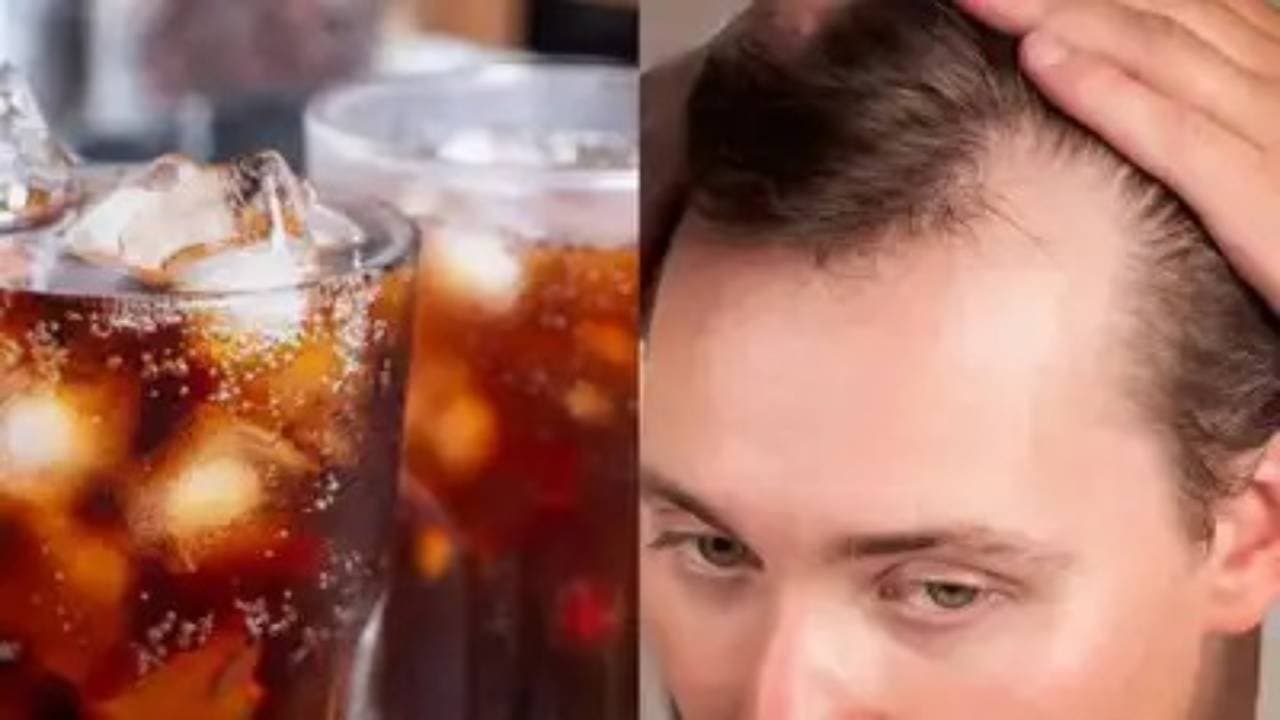 Drinking more than one sweetened drink daily shown to increase baldness risk by 42 percent